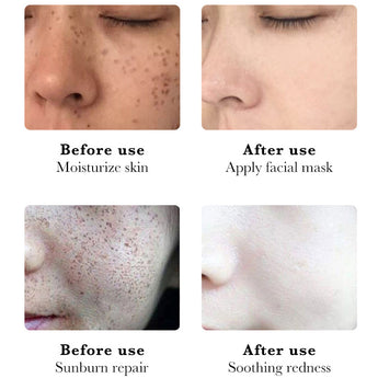 Niacinamide Whitening Freckles Facial Mask Remove Melasma Dark Spot Lightening Melanin Removal Moisturize Brighten Face SkinCare - Elite Hub Essentials